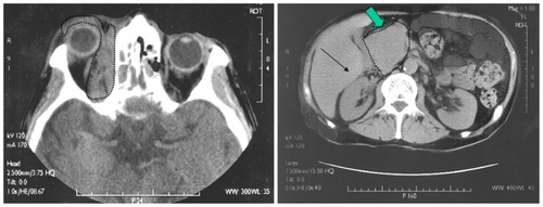 Figure 5 Computed tomography of the maxillofacial region showing parenchymatous infiltrations at the level of the ethmoidal cells, optic nerve, and the medial and anterior periorbital region (dotted line).