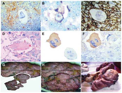 Figure 8 HCG immunopositivity localization related to embryoid body surrounding tissues and the walls of the triangular and hexagonal template platform where the structures are located. (A) H CG immunopositivity localization around inmmunonegativity embryoid body in a case of colon adenocarcinoma. (B) HCG-selective immunopositivity of the hexagonal template walls on which embryoid body is assembled in a case of undifferentiated sarcoma tumor. (C) HCG immunopositivity of surrounding tissue with inmmunonegativity of embryoid body structured inside hexagonal template platform in a case of renal cell carcinoma. (D) HCG selective spot walls immunopositivity of hexagonal geometric pattern in a case of papillary thyroid carcinoma. (E) Detachment subimage of (F) showing HCG selective immunopositivity of malignant giant cell in which two negative embryoid bodies are structured in their interior. Neighboring giant cell showing HCG immunonegativity, in a case of malignant fibrous histiocytoma. In Macroscopic fully developed malignant tumors is possible to identify spatial temporal organization that clearly reminds tissues fetus-placenta positional identities. (G) Detachment subimage of (H) a case of leiomyosarcoma. (I) Case of colon adenocarcinoma.Abbreviation: HCG, human chorionic gonadotropin.