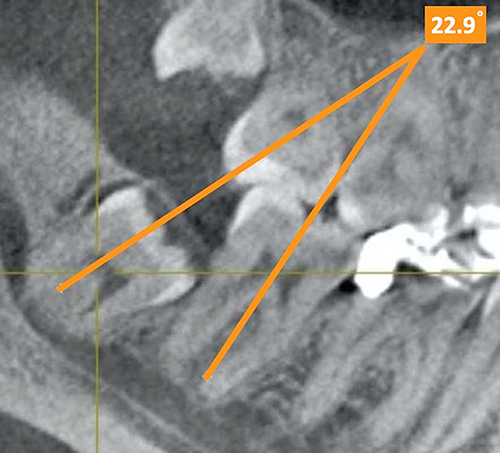 Figure 4 Winter’s classification, showing a mesioangular impaction.