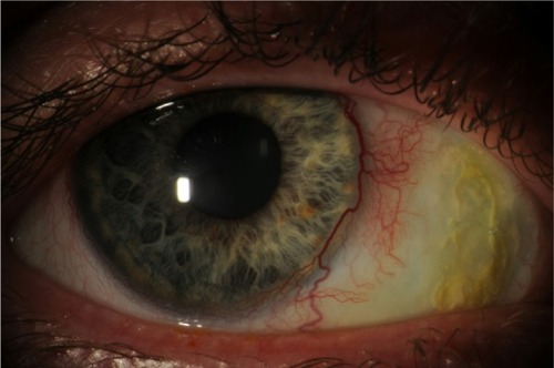 Figure 1 Photograph of nasal scleral thinning with overlying calcified plaques of the right eye.