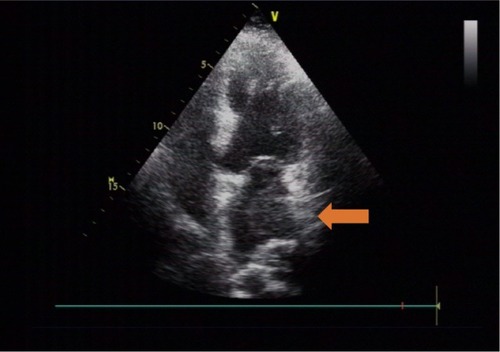 Figure 2 Hyperechoic lumpy mass detected on transthoracic echocardiography.