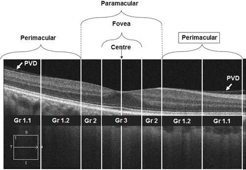 Figure 2 An example and a schematic diagram of a SD-OCT horizontal radial scan image. The PVD classification based on the PVD location. The above picture shows the PVD extended till perimacular area with grade 1.2.