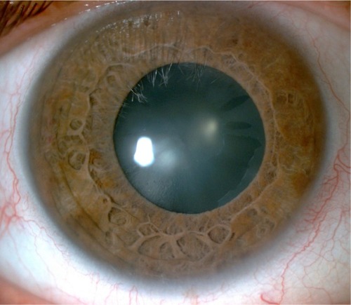 Figure 1 Slit lamp photograph showing signs of cataract and pseudoexfoliation.