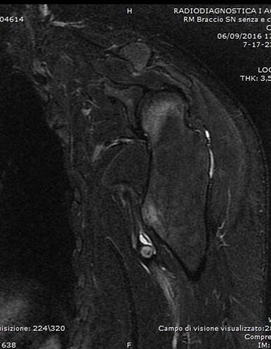 Figure 6 MRI with a STIR sequence showing the pseudoaneurysm after drainage of the hematoma (Case #2).