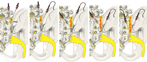 Figure 2 Leapfrog Radiofrequency Ablation Technique: A bipolar radiofrequency ablation strategy utilizing two probes placed within 10mm of one another along the SIJ. A lesion is made before moving the superior probe inferior to the second probe. A lesion is made, and the process is repeated with the lead probe being positioned inferiorly once again. Original medical illustration by Kamil Sochacki, DO.