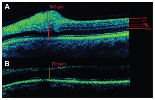 Figure 3 Cirrus HD-OCT (Carl Zeiss Meditec Inc, Dublin, CA) scans across the area of the cotton-wool spot: at presentation showing a maximum overall retinal thickness of 506 μm with focal thickening of the retinal nerve fiber layer (A); and 9 weeks later showing a corresponding overall retinal thickness of 229 μm (B).