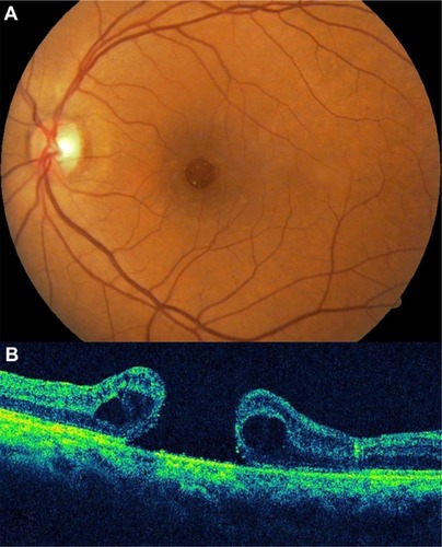 Figure 9 A case of a Stage 4 macular hole.