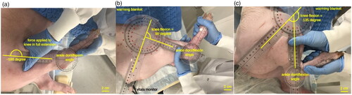 Figure 1. Goniometry measurement of the ankle range of motion with the knee stabilized in (a) full extension, (b) 90 degrees of flexion, and (c) 135 degrees flexion, While the angle of the ankle at maximal dorsiflexion is measured.