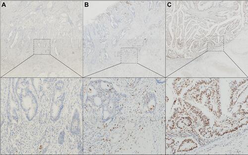 Figure 1 Immunohistochemistry for TLR3. (A) TLR3 was not stained for tumor cells. (B) TLR3 was weakly stained around the nucleus. (C) TLR3 was strongly stained around the nucleus and weakly for the cytoplasm (Magnification: upper 40×, lower 200×).