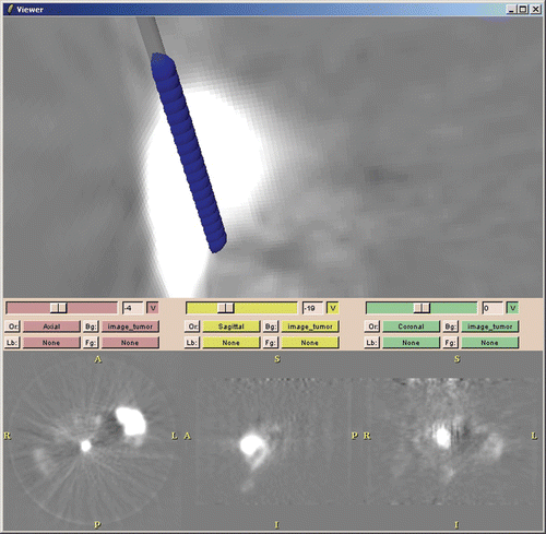 Figure 3. 3D Slicer screen showing defined measurement track (dark blue cylinder) and tumor (bright white object) in PET image. [Color version available online.]