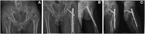 Figure 2 (A) Preoperative X-ray showing intertrochanteric fracture. (B) Postoperative X-ray showing poor reduction, the lateral position shows that the anterior cortex of the femur was obviously cortical encroachment. (C) One month later, the patient fell down resulting in fracture around the intramedullary nail of the femoral shaft.