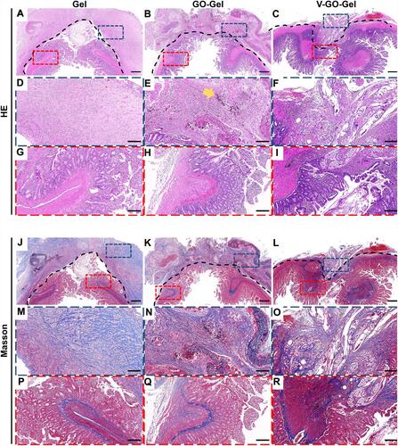 Figure 6 Histological analysis of the vascularized scaffolds 4 weeks after perforation surgery. Panoramic view of the H&E staining (A–C) and Masson’s trichrome staining (J–L) of the intestinal wounds acquired on week 4 after treatment with different scaffolds. (scale bar=500μm). High magnification images of the HE staining (D–I) and Masson’s trichrome staining (M–R) of intestinal wounds acquired on week 4 after treatment with different scaffolds (scale bar=100μm). The yellow arrow indicates the residual graphene oxide sheet.