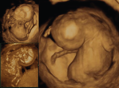 Figure 29.  Extreme hyper-dorsiflexion seen in a case of trisomy 21 at 14 weeks of gestation. Left upper and right; 3D reconstructed oblique anterior and lateral views of the fetus. Left lower; 3D maximum mode demonstrating bony structure.