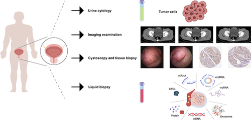 Figure 4 Exosomes as Potential Biomarkers in BCa. The primary diagnostic methods for bladder cancer include: initial screening and diagnosis through urine cytology and cystoscopy; subsequent use of imaging tests such as CT to understand the extent of the mass and metastasis; and finally invasive cystoscopy and pathology of the material taken to provide a definitive diagnosis. With the concept of “liquid biopsy”, a large number of small molecules with biological information, such as exosomes, have high specificity and sensitivity for the diagnosis of bladder cancer, and have the potential to serve as biomarkers for bladder cancer.