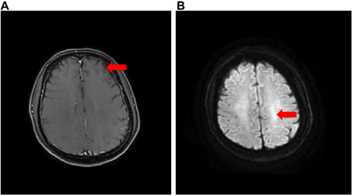 Figure 1 Brain magnetic resonance imaging (MRI) The red arrows in Figure 1 indicate the possible location of the lesion. (A) left parietal lobe and occipital lobe. (B) left centrum semiovale abnormal signal, considering the possibility of inflammation.