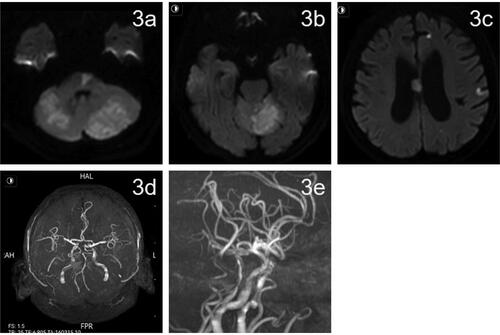 Figure 3. Cranial magnetic resonance imaging on postoperative day 3.(a–c) Postoperative day 3 MRI DWI showed multiple fresh cerebral infarcts in the pons, cerebellar vermis, bilateral cerebellar hemispheres, frontoparietal temporal lobe, and corpus callosum. (d, e) MRA on postoperative day 3 showed local luminal stenosis of the middle basilar artery (shown by red arrows).
