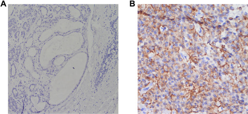 Figure 6 Immunohistochemical staining (EnVision Method). (A) CCNB2 is negatively expressed in the adjacent nontumor tissue at ×400 magnification. (B) CCNB2 is positively expressed in the triple-negative breast cancer tissue (magnification, ×400).