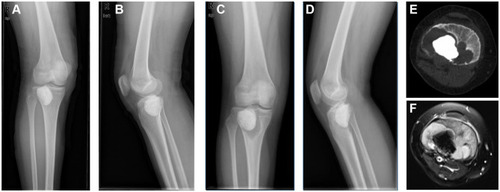 Figure 4 Radiological images of the proximal right tibia. Radiograph (A and B), postoperative films following the curettage and packing with cement; Radiograph (C and D), and CT (E, bone window) showed a circumferential lucency around the bone cement and local cortical bone destruction. MRI (F, T1-weight) showed a soft tissue mass.