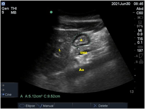 Figure 1. Preoperative gastric sonogram. The sonogram shows a sagittal scan of an empty gastric antrum. L: liver; A: gastric antrum; SMA: superior mesenteric artery; Ao: aorta.