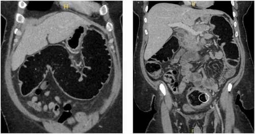 Figure 1. Large intestinal obstruction and nondistended sigmoid colon at the level of the proximal stent suggestive of occluded stent