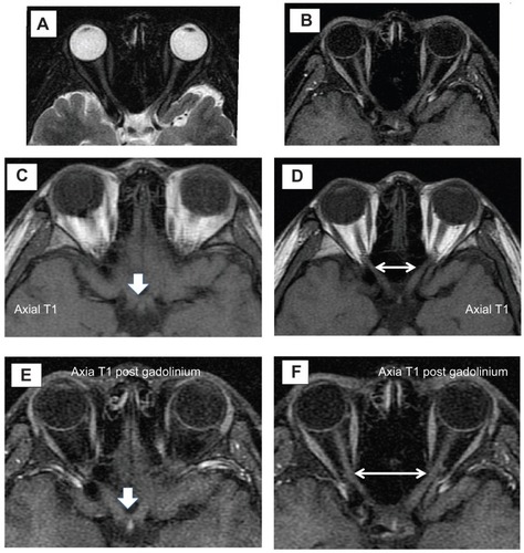 Figure 2 (A and B) MRI of the optic nerve shows expansion with slight increase signal intensity on T2-weighted image involving both optic nerves (left) and enhancement in T1-weighted image post IV contrast. (C–F) MRI of the optic nerve (white arrow) and both optic nerves (white double arrowheads) shows expansion and enhancement on T1-weighted image and post gadolinium images.
