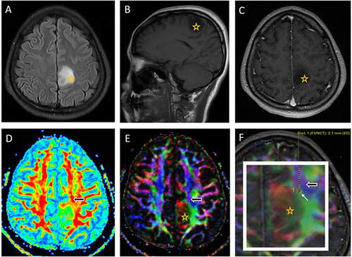 Figure 1 Diffusion tensor imaging of the brain of a 34-year-old woman with a left frontal–parietal diffuse astrocytoma (grade II). Axial fluid-attenuated inversion recovery (A), pre-contrast T1-weighted (T1W) (B), and post-contrast T1W (C) images show a homogenous tumor (indicated by a star in (A–F), with no enhancement and no peritumoral edema. The tumor appears to slightly and laterally compress the left corticospinal tract (CST) (indicated by black arrow in (D–F). The combination of the color-coded map and post-contrast T1W (F) shows a glioma-to-CST distance of 2.1 mm (indicated by white arrow).