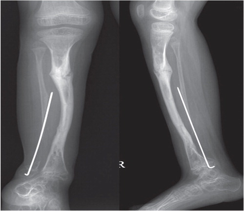 B. Anteroposterior and lateral radiographs from the child after attempted Ilizarov fixation with intramedullary rodding. The intramedullary rod had to be removed due to infection, and there was severe ankle valgus.