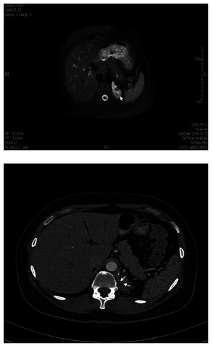 Figure 1 A) Magnetic resonance image of the undetermined retroperitoneal left subdiaphragmatic mass (2.36 × 8.53 cm, arrow). B) Axial postcontrast arterial-phase computed tomographic image of undetermined retroperitoneal left subdiaphragmatic mass (2.36 × 8.53 cm, arrows) with small calcifications inside.