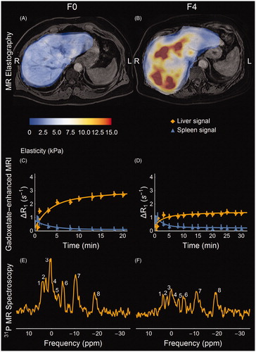 Figure 2. MR-based biomarkers for a non-fibrotic (A, C, E) and a cirrhotic (B, D, F) NAFLD patient. (A, B) MR shear-wave elastograms at 56 Hz. The elastograms are superimposed on water-only gadoxetate-enhanced Dixon images. (A) shows the homogenously soft tissue in the non-fibrotic liver compared to (B), in which the excessive fibrous tissue is apparent both in terms of absolute values and in heterogeneity. (C, D) Relative induced change in relaxivity due to the presence of the MR contrast agent gadoxetate in the liver and the spleen respectively, proportional to the concentration of gadoxetate. The solid lines represent the predictions made by the mathematical model describing the function of the OATP1 and MRP2 transporter proteins in the hepatocytes. As can be seen the cirrhotic liver accumulates much less gadoxetate within the liver parenchyma than the non-fibrotic liver. (E, F) 31P-MR spectral assignments with (1) phosphomonoesters (PME); (2) inorganic phosphate (Pi); (3) phosphodiesters (PDE); (4) membrane phosphates (MP); (5) trace of phosphocreatine originating from surrounding muscle tissue; (6–8) nucleotidetriphosphate (γ-NTP, α-NTP, β-NTP, mainly Mg-ATP); at the up-field base of resonance (7) NAD(H) is also present. As can be seen, PME increases and PDE decreases in the cirrhotic patient; these are combined into 'anabolic charge' (AC). Colour version of the figure is available in the online version.