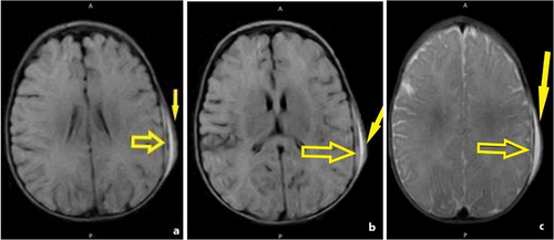 Figure 6 5-month-old baby fell from 2 feet. (a and b) Left-sided parietal subdural hematoma (yellow arrow)- A crescent-shaped collection with high-intensity FLAIR signal; hyperintense epicranial left parietal hematoma (yellow arrow) on FLAIR. (c) isointense T2 signal; T2-weighted imaging epicranial left parietal hematoma (yellow arrow).