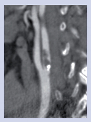 Figure 1. Contrast-enhanced computed tomography scan of an acute internal carotid artery plaque rupture and intraluminal thrombus.