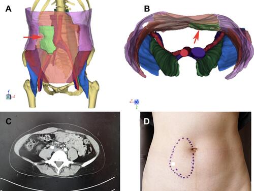 Figure 3 Primary abdominal wall tumor. (A) Three-dimensional reconstruction of tumor. Red arrow indicates tumor (green marker). (B) Three-dimensional reconstruction view from above. Red arrow indicates tumor (green marker). (C) Transverse section examination of CT. (D) Abdominal wall.