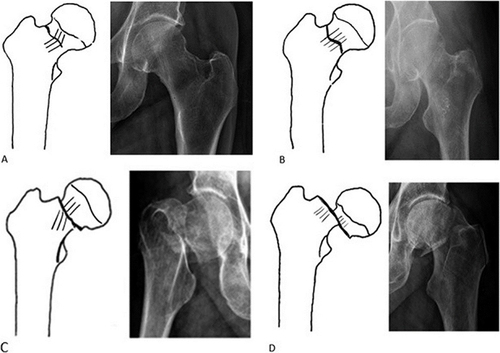 Figure 1 Garden classification system of femoral neck fractures. (A) Garden Type I. (B) Garden Type II. (C) Garden Type III. (D) Garden Type IV.