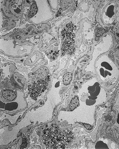 Figure 2.  Electron microscopy findings. Myeloid bodies are seen in the glomerular epithelial cells. A few mesangial inclusions are also present (original magnification ×2150).