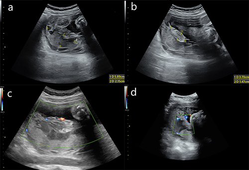 Figure 2 Follow-up ultrasound images. The lesion gradually transformed into (a) a local hypoechoic area of the placenta accompanied by (b) focal heterogeneous strong echo and decreased in size. It was (c) measured approximately 7.0×3.4×5.0 cm at 29 weeks and approximately (d) 3.9×3.9×4.2 cm at 36+6 weeks of gestation.