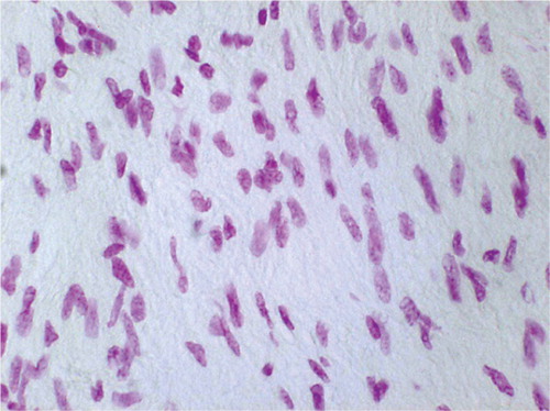 Figure 3. Feulgen staining at 3 weeks after radiofrequency treatment without immobilization. Cellularity was significantly increased. The fibroblasts appeared large and rounded/oval in shape, which was combined with intense depth of staining. The histomorphology indicates a vast amount of DNA and cell activity (original magnification: × 750).