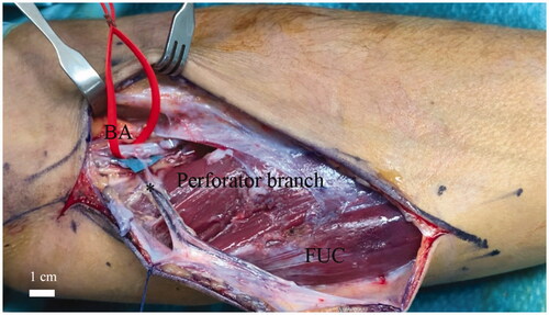 Figure 3. Single case (one out eight specimens) in which the perforator (*) originated directly from the brachial artery above the ulnar fold. The red string indicates the brachial artery (BA). Flexor carpi ulnaris muscle (FUC). Scale bar (1 cm).