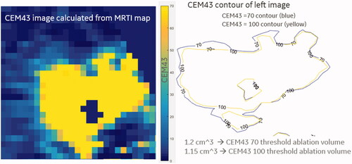 Figure 4. CEM43 dose maps. Left – Pixel grid of CEM43 dose delivered via NBTU. Right – CEM43 isodose lines derived from the pixel grid. The volume of the necrotic zones was calculated by counting the pixels at the specified CEM43 threshold and multiplying by the 3 pixel dimensions.