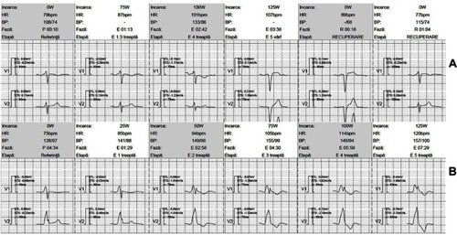 Figure 2 LV pacing during exercise outside the fusion pacing band.