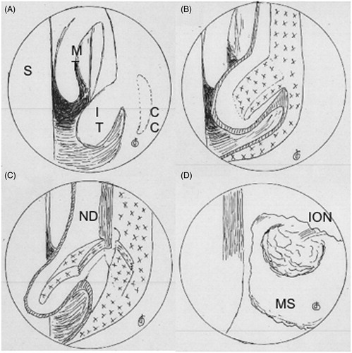 Figure 3. Schemas of endoscope during surgery. The preincisional view is shown in A. The bone of the inferior turbinate and the medial wall of the maxillary sinus were revealed (B). The bone of the inferior turbine and the nasolacrimal duct were revealed (C). The maxillary sinus and the orbital contents within it were observed (D). S: nasal septum; MT: middle turbinate; IT: inferior turbinate; CC: concha crest; ND: nasolacrimal duct; MS: maxillary sinus; ION: infraorbital nerve.