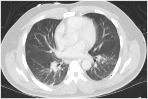 Figure 3. CT chest on hospital day 58 (five days prior to discharge) demonstrating improvement of the bilateral opacities compared to Figure 2