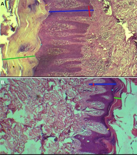 Figure 1 (A) Histopathology of psoriasis (H&E ×100). (B) Histopathology of chronic dermatitis (H&E ×100).