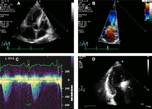 Figure 1. Echocardiographic images before and during alcohol septal ablation. Long-axis apical view depicting typical features of hypertrophic obstructive cardiomyopathy including asymmetric septal hypertrophy and severe systolic anterior motion of the mitral valve (A). Left ventricular outflow tract obstruction was demonstrated by Color flow Doppler (B) and continuous wave Doppler (C) with a maximal instantaneous gradient of 101 mmHg at rest. Long-axis apical view during contrast administration shows potential area of necrosis in the basal anteroseptum (arrow) immediately prior to alcohol septal ablation (D).