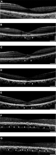 Figure 2 Fourier-domain optical coherence tomography (FD-OCT) images (horizontal scan) of normal eye (A), and right/left eyes of patient 1 (B, C), patient 2 (D, E), patient 3 (F, G), and patient 4 (H, I). Horizontal bars represent 500 μm, and vertical bars represent 200 μm. The eyes in patients 1–4 had a bilateral symmetric decline in visual acuity, whereas those in patient 5 had an assymmetric decline (20/200 right eye, 20/20 left eye). FD-OCT in normal eye provided clear images of the retinal layers. The external limiting membrane (ELM), photoreceptors inner and outer segment (IS/OS) junction, third line, and retinal pigment epithelium (RPE) are distinguishable. Meanwhile, the retinal photoreceptor layer is not clear in the eyes of the patients. Although ELM was visualized in all eyes, IS/OS is elevated and disrupted in fovea (B, C, D, E, H), widely disrupted and not clear (F, G), and clearly visualized in one eye (I). The third line was visualized only in one eye (I), just in the fovea.