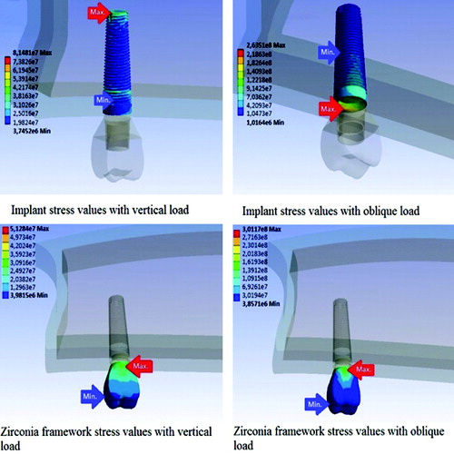 Figure 3. Stress analysis of the maxillary implant-supported crown.