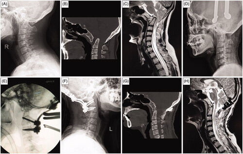 Figure 2. (A) 34-years-old female with BI, AAD and syringomyelia was treated by posterior atlantoaxial joint release, lever and distraction reduction, occipitocervical fixation. (A) Preoperative lateral X-ray showed BI; (B) Preoperative CTmedian sagittal reconstruction presented AAD, assimilation of the atlas; (C) Preoperative MRI median sagittal T2W1 showed odontoid process intrusion into the foramen magnum and compression to CMJ; (D) Preoperativelateral X-ray showed the partial reduction of the odontoid after a large weight of the skull traction (1/6 BW); (E) Intraoperative atlantoaxial joint release, lever reduction, implantation of 9 mm cage with autogenous bone into atlantoaxial facet joint and occipitocervical fixation was performed; (F) Postoperative lateral X-rays of the cervical spine showed good internal fixation position;(G) Postoperative CT median sagittal reconstruction showed odontoid process migration outside from the foramen magnum and full reduction of AAD; (K) Postoperative MRI median sagittal T2W1 showed the elimination of CMJ compression and disappearance of syringomyelia after surgery.
