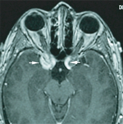 Figure 1 Case 1. Initial T1-weighted, axial MRI after intravenous injection of paramagnetic contrast material shows enhancing lesions surrounding the anterior clinoid processes (arrowheads). The right lesion is larger than the right and may be extending through the superior orbital fissure.