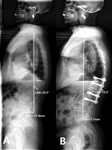 Figure 4. Case 2. PSV + VP. A 69-years old female patient complained refractory low back pain with functional dyspepsia which was persistent for about 6 months without any injury. A: Preoperative full-length spine X-ray of the same patient show local kyphosis angle is 25.2°, the sagittal vertical axis(SVA) is -47.8 mm. B: at the last follow up(33 months after operation), full-length spine X-ray show local kyphosis angle is 15.2°, the sagittal vertical axis(SVA) is 11.7 mm, the cement and internal fixation keeps in the original place.