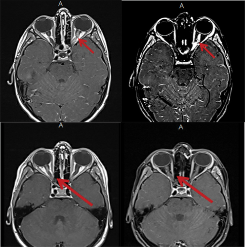 Figure 1. MRI Brain showing recurrent optic nerve enhancements; initially left sided and subsequently right sided.