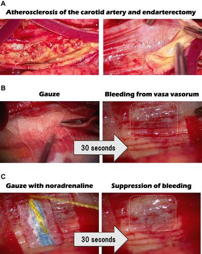 Figure 4 Carotid endarterectomy of a patient with 90% stenosis of the cervical artery. (A) Atherosclerosis of the carotid artery and endarterectomy; (B) Gauze was applied for the bleeding which occurred after peeling off the intimal atheromatous layer of the carotid artery; (C) Gauze, dipped in the catecholamine noradrenaline, was applied and inhibited the bleeding, indicating that the blood supply of the intimal atheromatous lesion was from the vasa vasorum and that it was stopped by contraction of the medial smooth muscle cells.